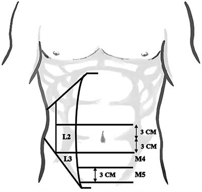Non-closure of the Free Peritoneal Flap During Laparoscopic Hernia Repair of Lower Abdominal Marginal Hernia: A Retrospective Analysis